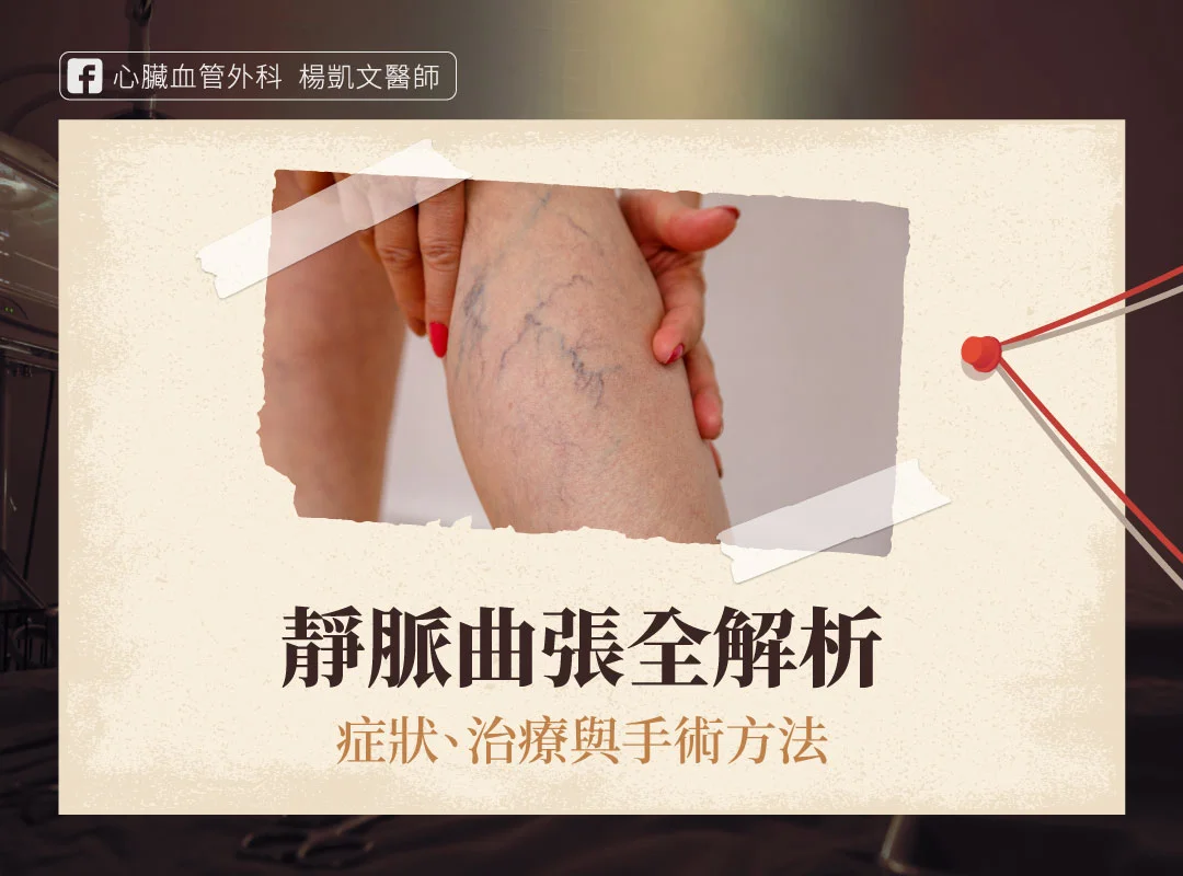 靜脈曲張 症狀 治療 手術