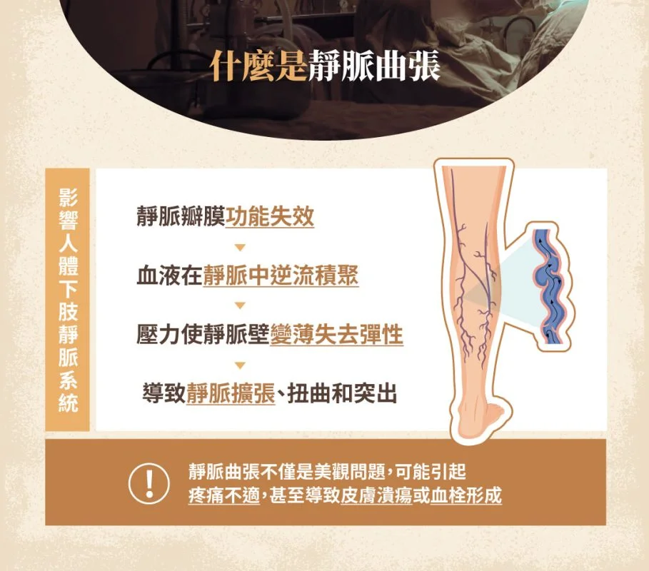 靜脈曲張 說明