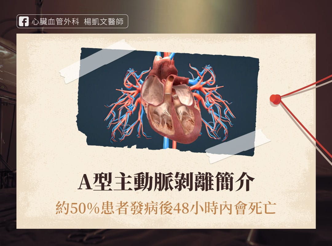 A型主動脈剝離