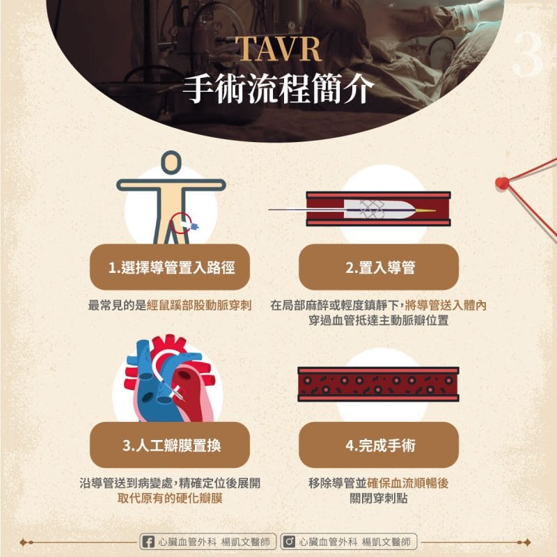 TAVR 手術流程