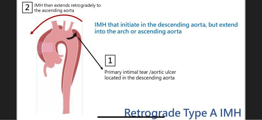 逆行型A型 主動脈剝離
